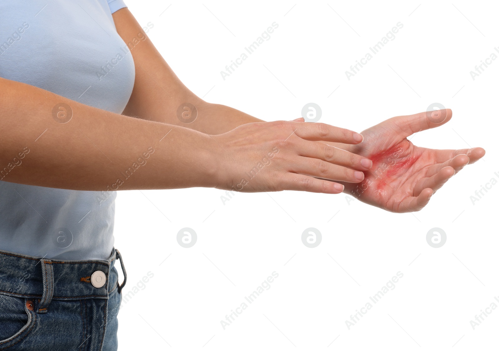 Photo of Woman with burned hand on white background, closeup