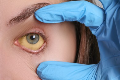 Photo of Doctor checking woman with yellow eyes, closeup. Symptom of hepatitis