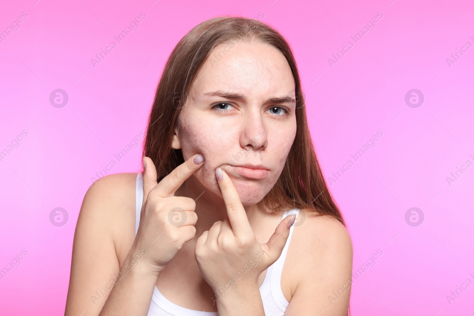 Photo of Young woman with acne problem on color background