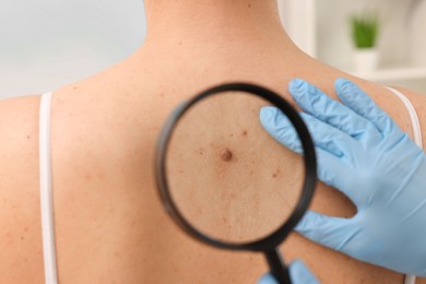 Dermatologist examining patient's birthmark with magnifying glass indoors, closeup