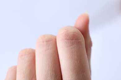 Photo of Woman with dry skin on fingers against light background, closeup