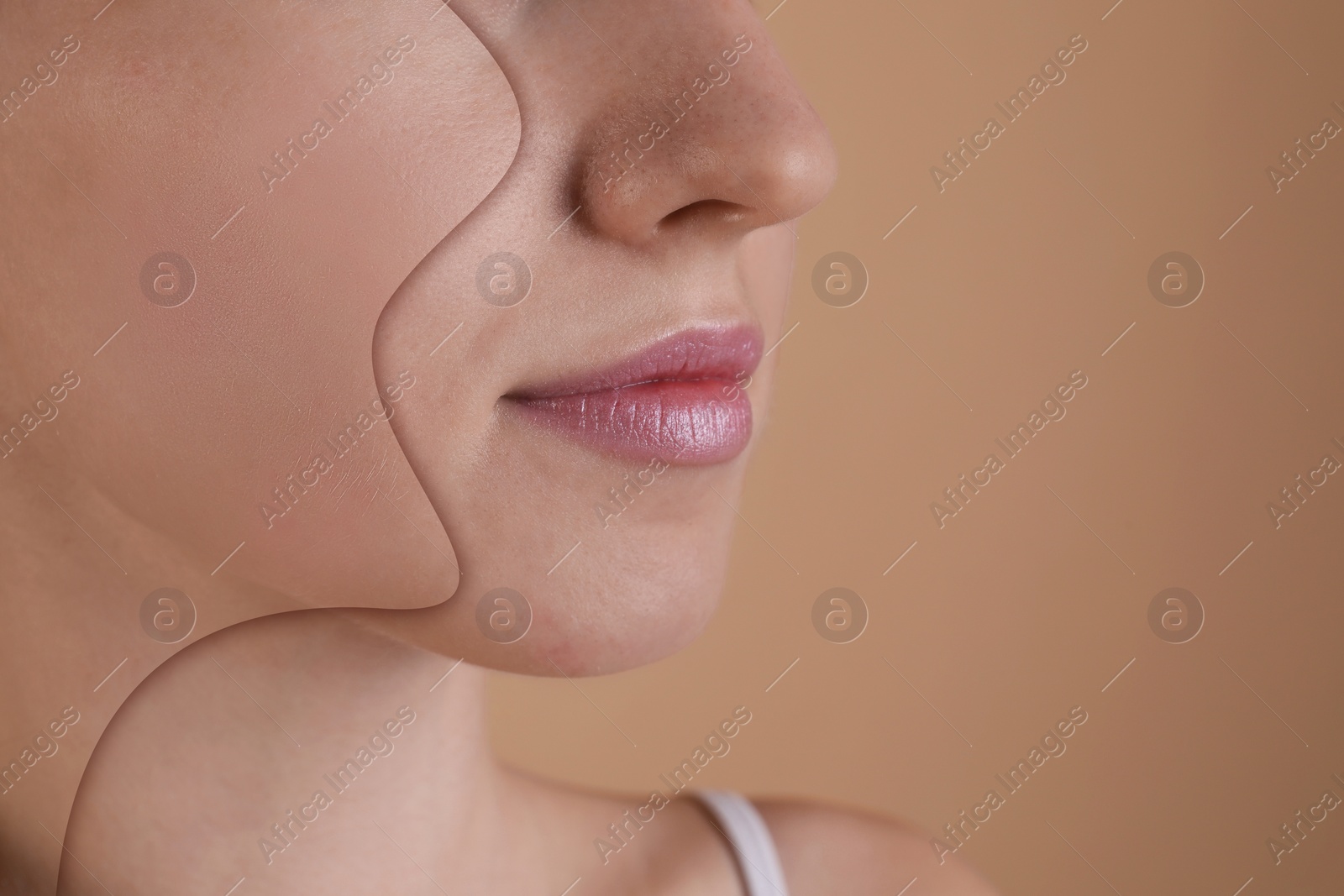 Image of Acne problem, collage. Woman before and after treatment on beige background, closeup. Space for text