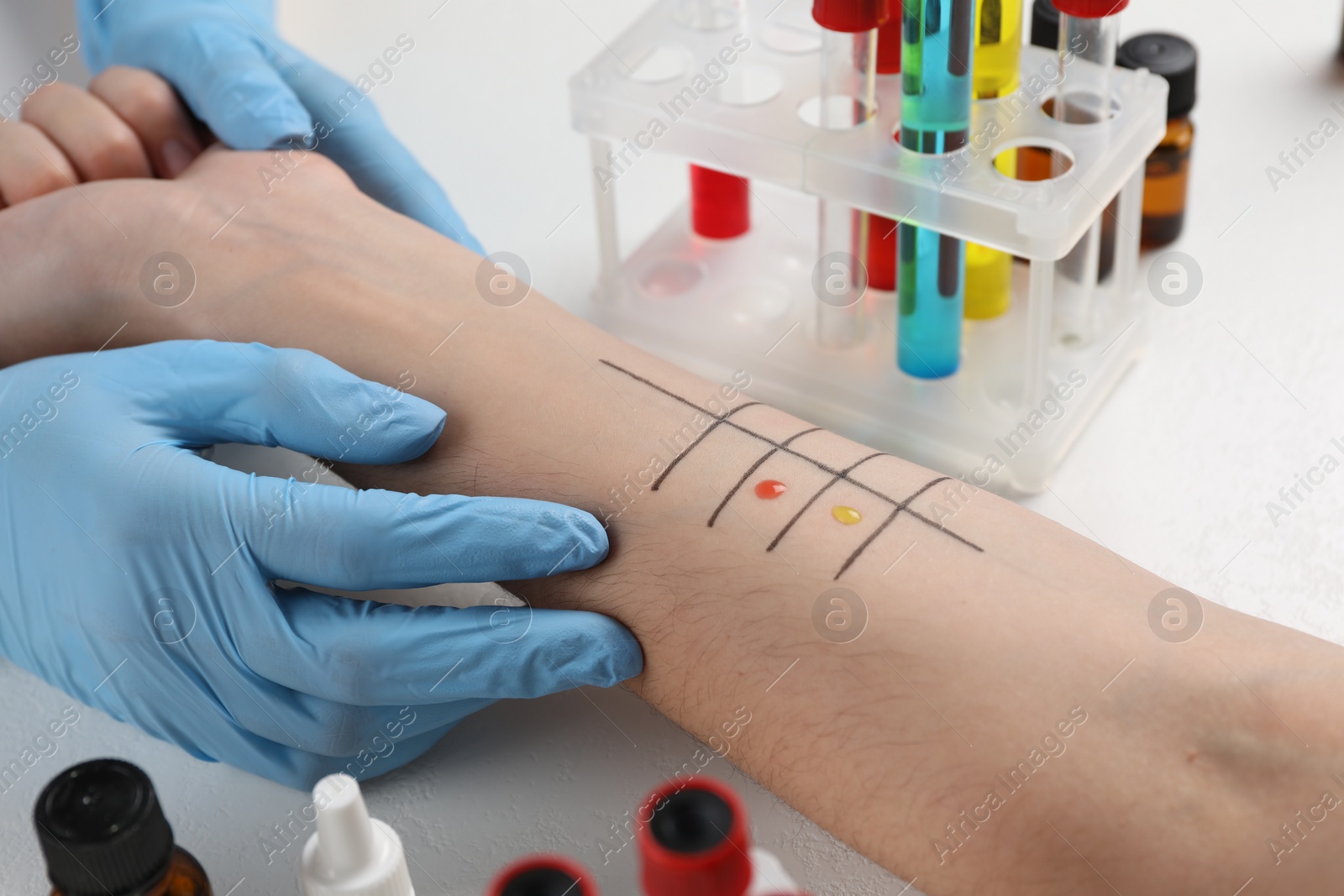 Photo of Patient undergoing skin allergy test at light table in clinic, closeup