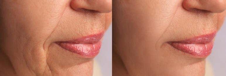 Image of Mature woman before and after skin tightening treatments. Collage with photos, closeup