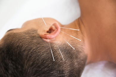 Young man undergoing acupuncture treatment in salon, closeup