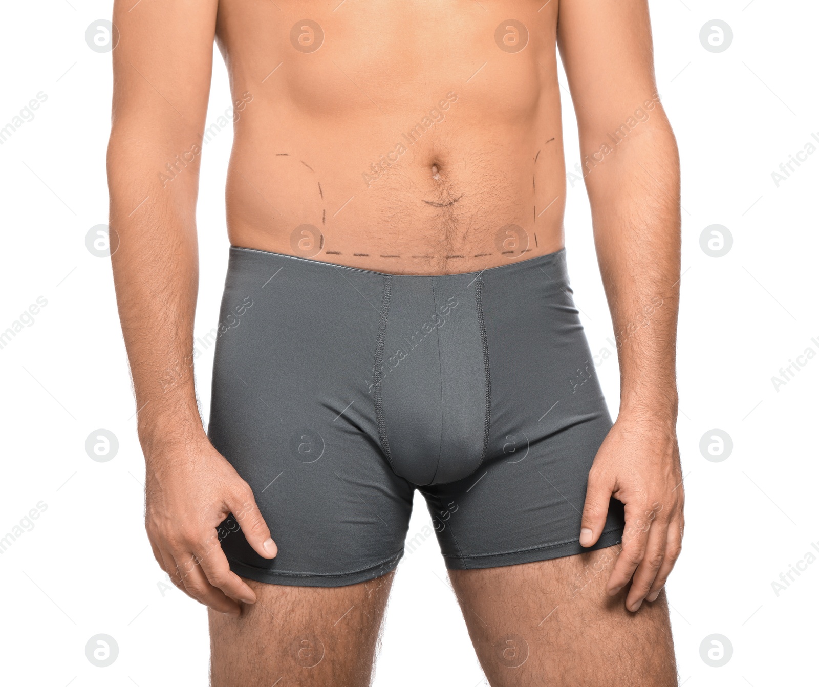 Photo of Man with markings on belly before cosmetic surgery operation on white background, closeup
