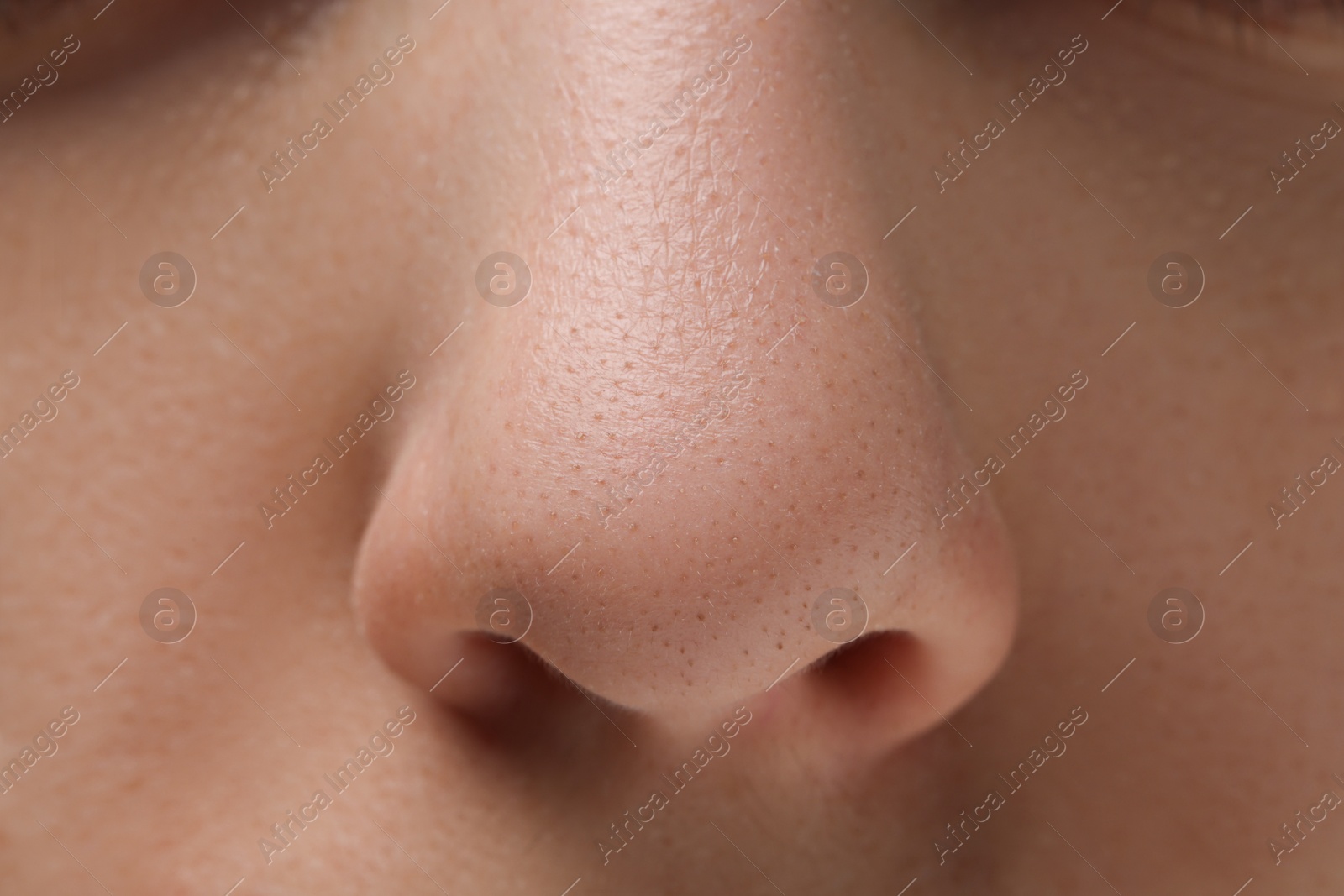 Photo of Young woman with acne problem, closeup view of nose