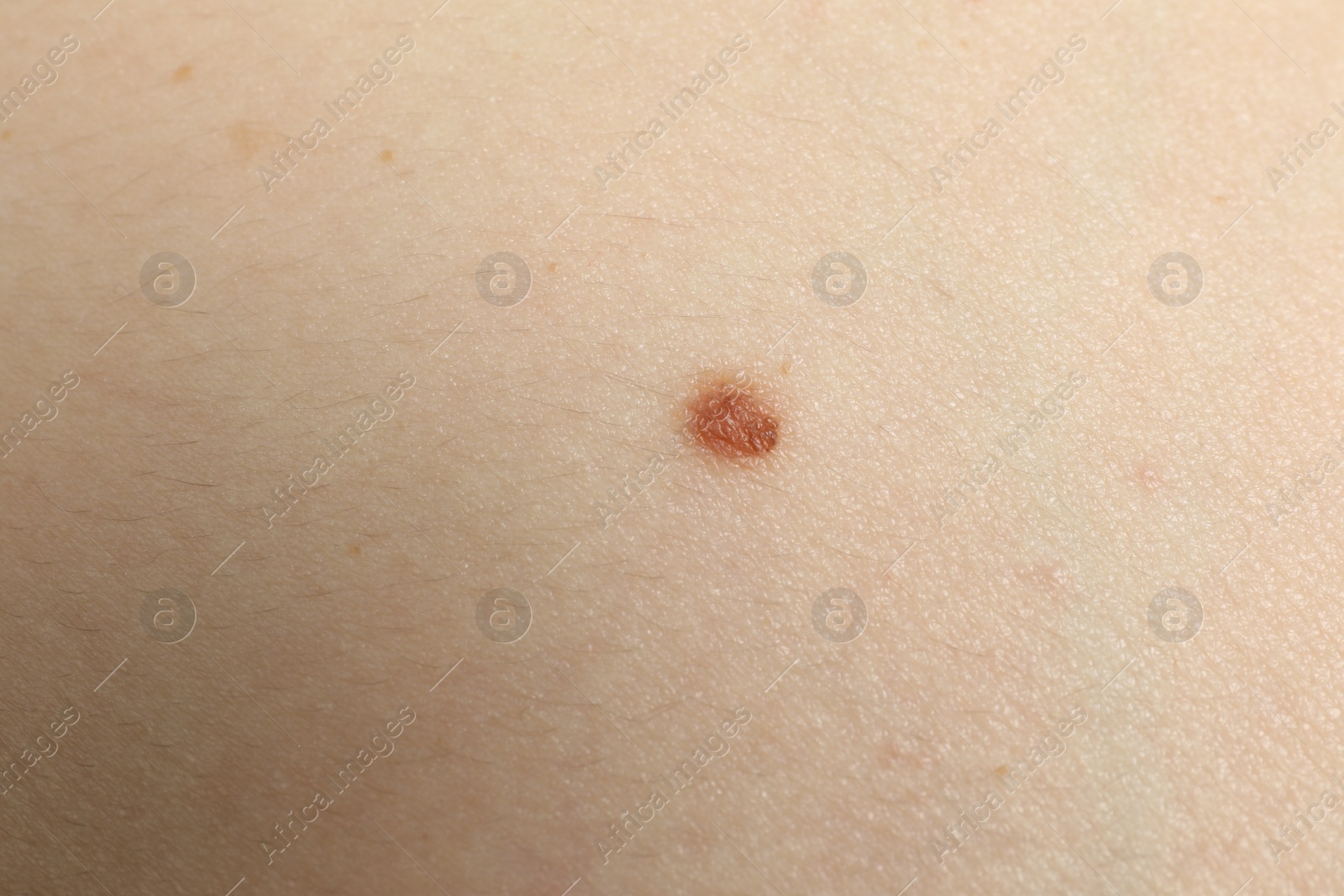 Photo of Closeup view of woman's body with birthmark as background