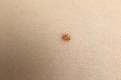 Closeup view of woman's body with birthmark as background