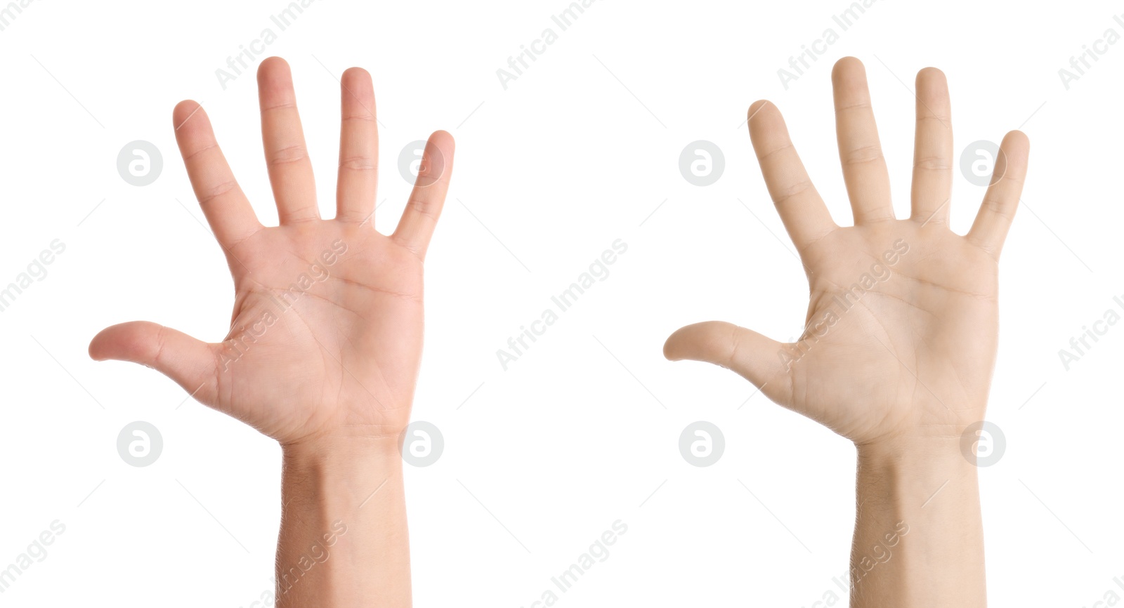 Image of Healthy and sick men showing palms on white background, closeup. Anemia symptom
