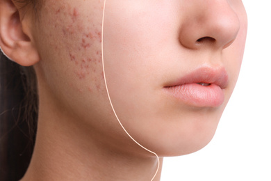 Image of Teenage girl before and after acne treatment on white background, closeup