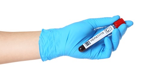 Scientist holding tube with blood sample and label Hepatitis C on white background, closeup