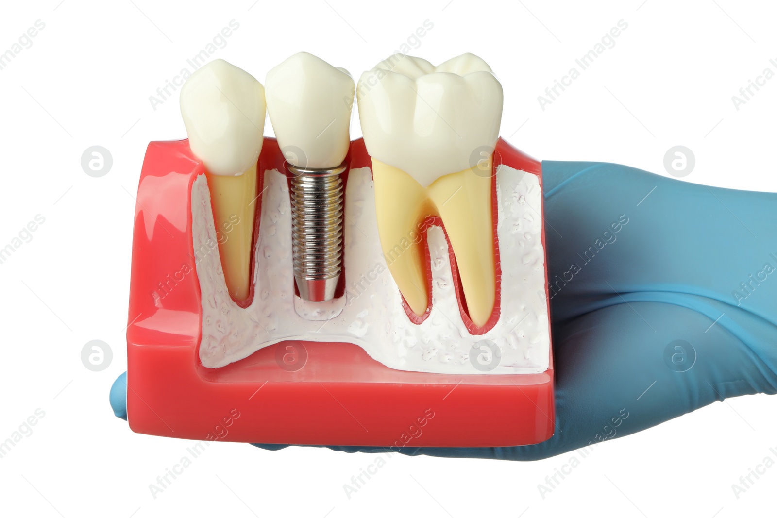Photo of Dentist holding educational model of gum with dental implant between teeth on white background, closeup