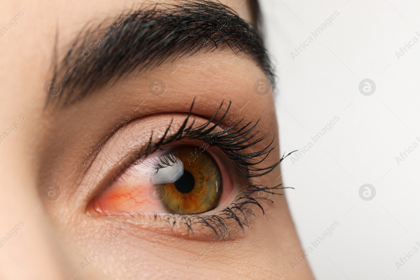 Image of Woman with red eye suffering from conjunctivitis on white background, closeup
