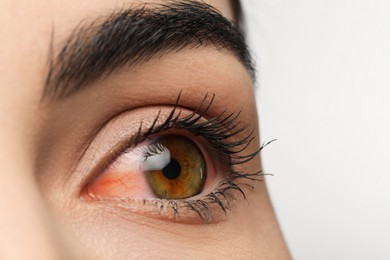 Woman with red eye suffering from conjunctivitis on white background, closeup