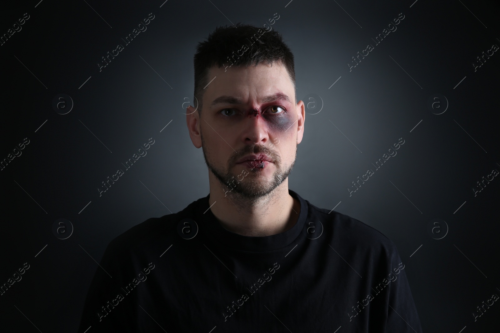 Photo of Man with facial injuries on dark background. Domestic violence victim