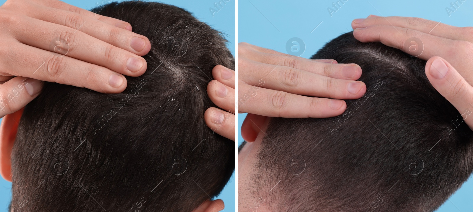 Image of Man showing hair before and after dandruff treatment on light blue background, collage