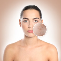 Woman with acne on her face on beige gradient background. Zoomed area showing problem skin