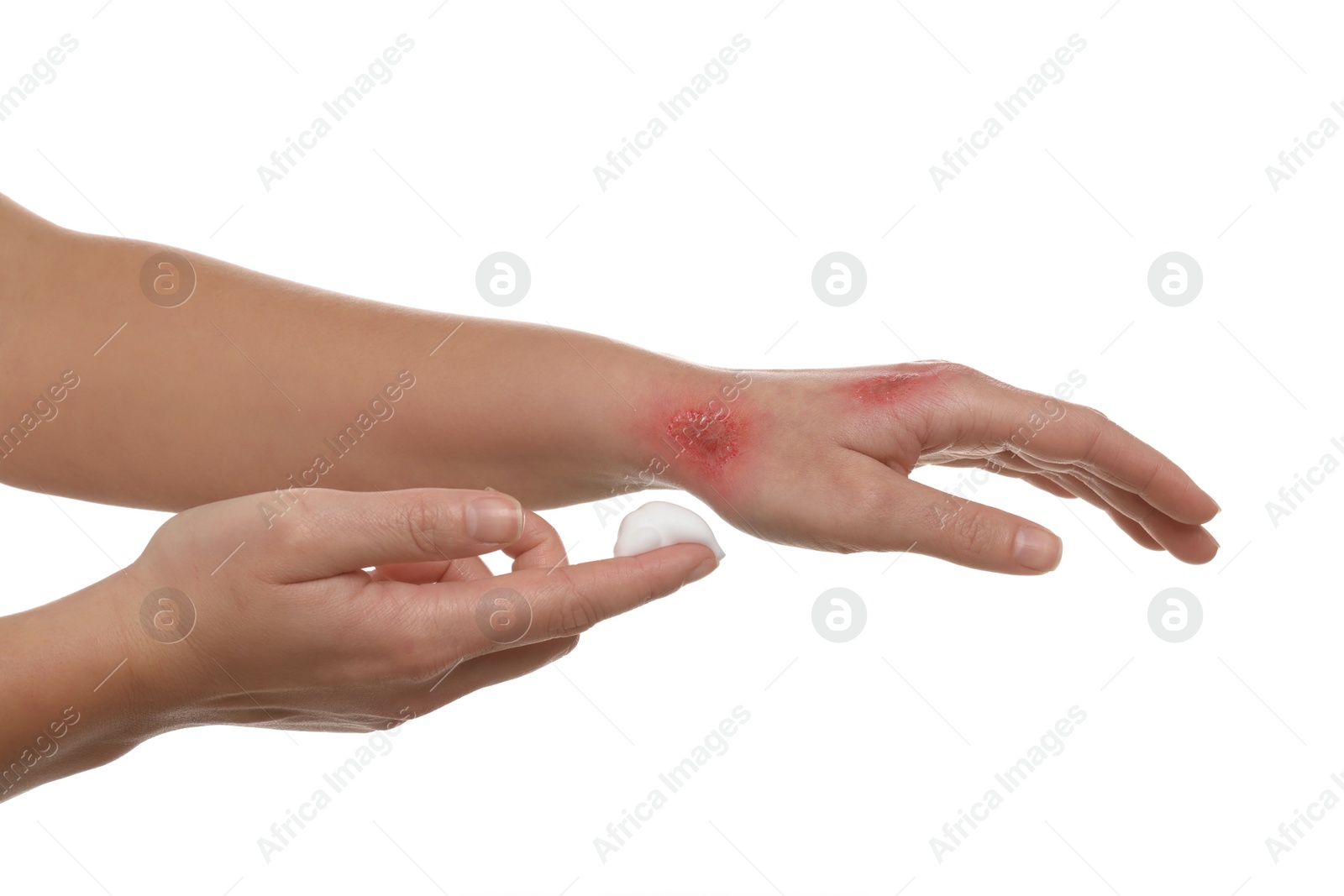 Photo of Woman applying panthenol onto burned hand on white background, closeup