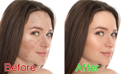Image of Young woman before and after cosmetic procedure on white background