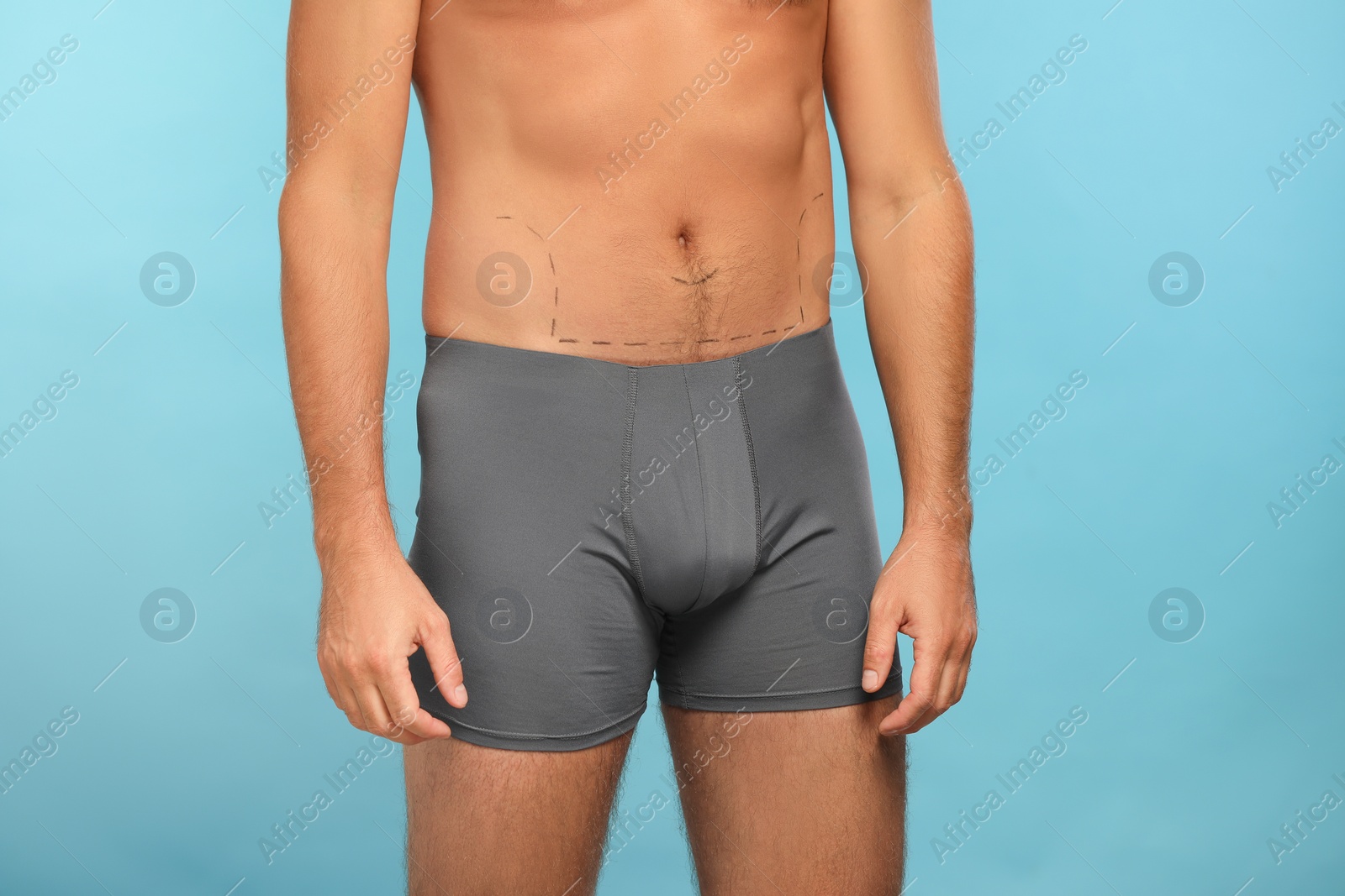 Photo of Man with markings on belly before cosmetic surgery operation on light blue background, closeup
