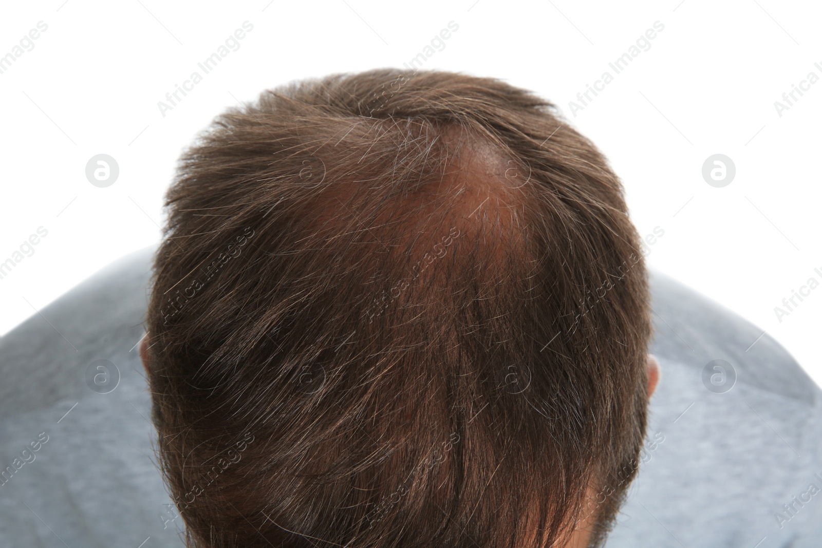 Photo of Man with hair loss problem isolated on white, above view