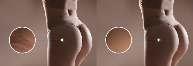 Image of Before and after cellulite treatment, zoomed smooth and dimpled skin. Collage with photos of slim woman in underwear on beige background, closeup