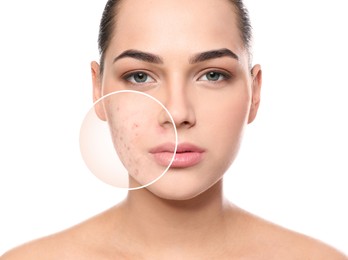 Woman with acne on her face on white background. Zoomed area showing problem skin