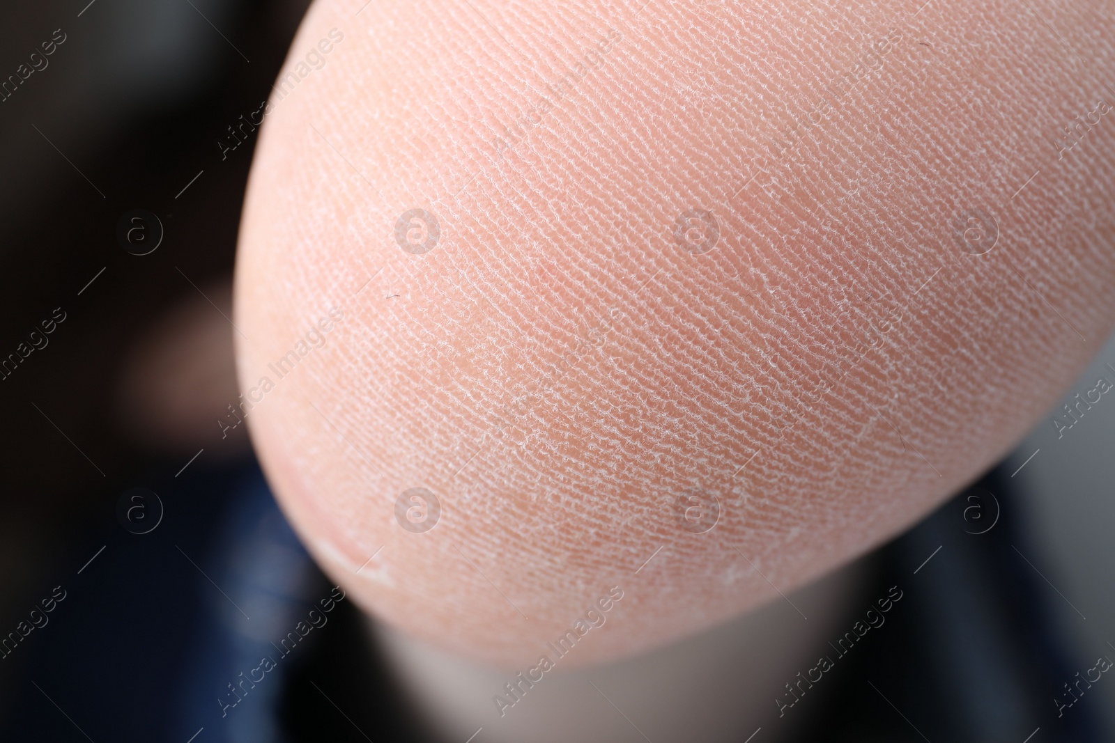 Photo of Woman with dry skin on foot, closeup