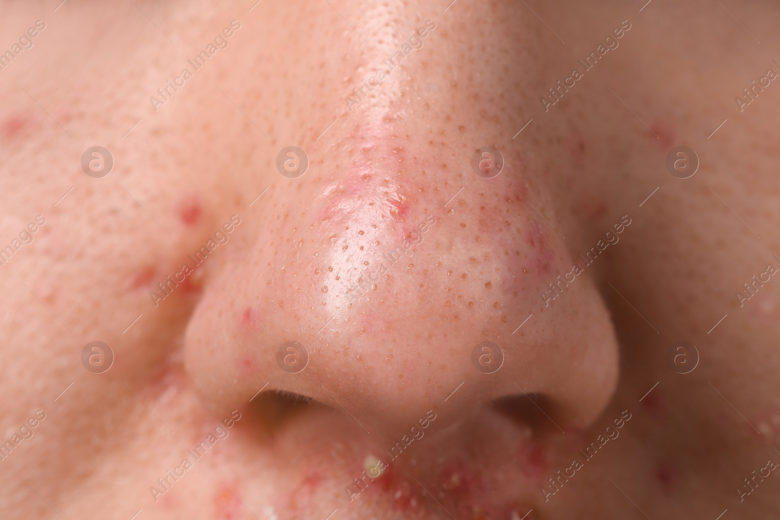 Photo of Young man with acne problem, closeup view of nose