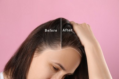 Image of Woman suffering from baldness on pink background, closeup. Before and after treatment, collage
