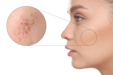 Dermatology. Woman with skin problem on white background, closeup. Zoomed area showing acne