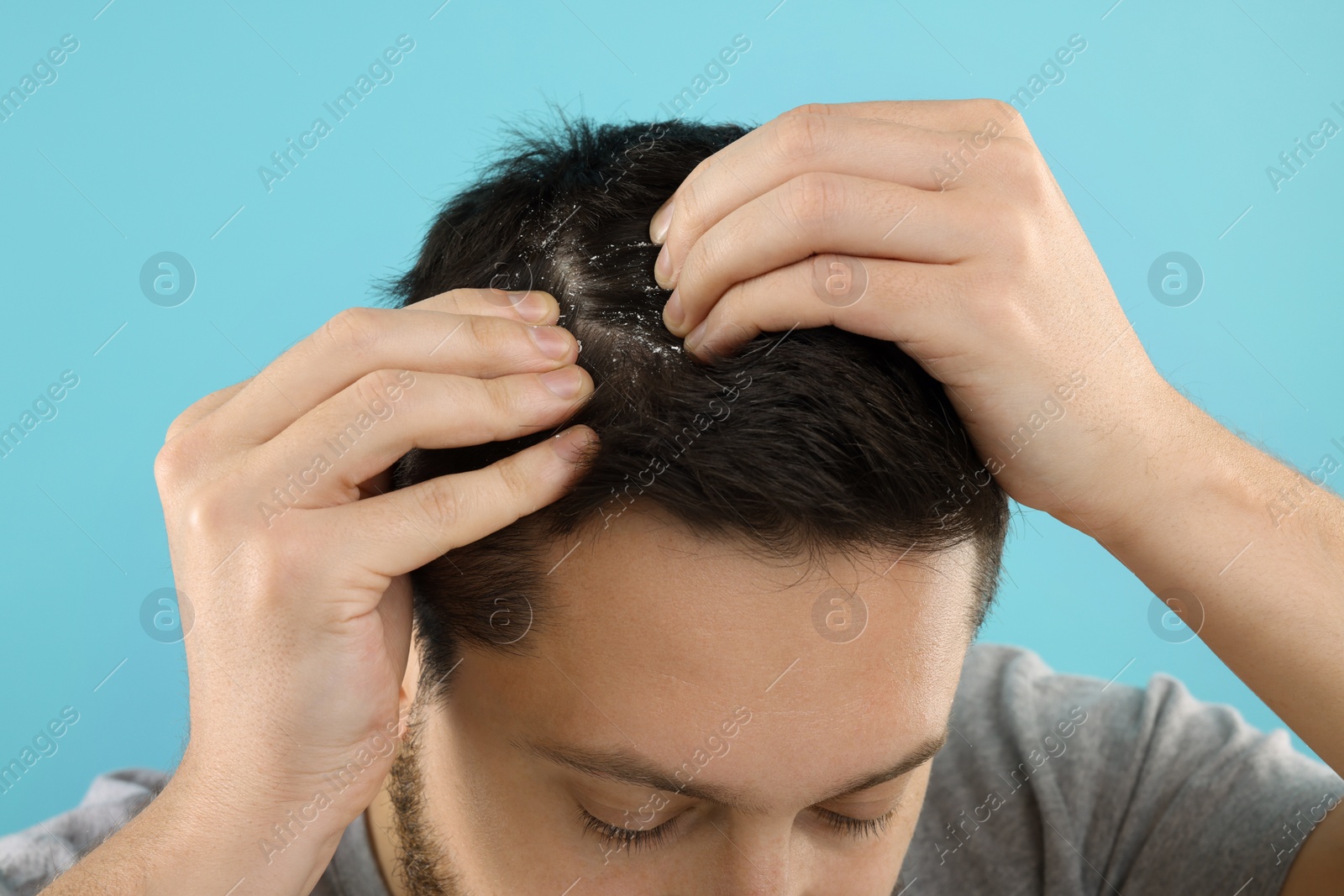 Photo of Man with dandruff in his dark hair on light blue background, closeup