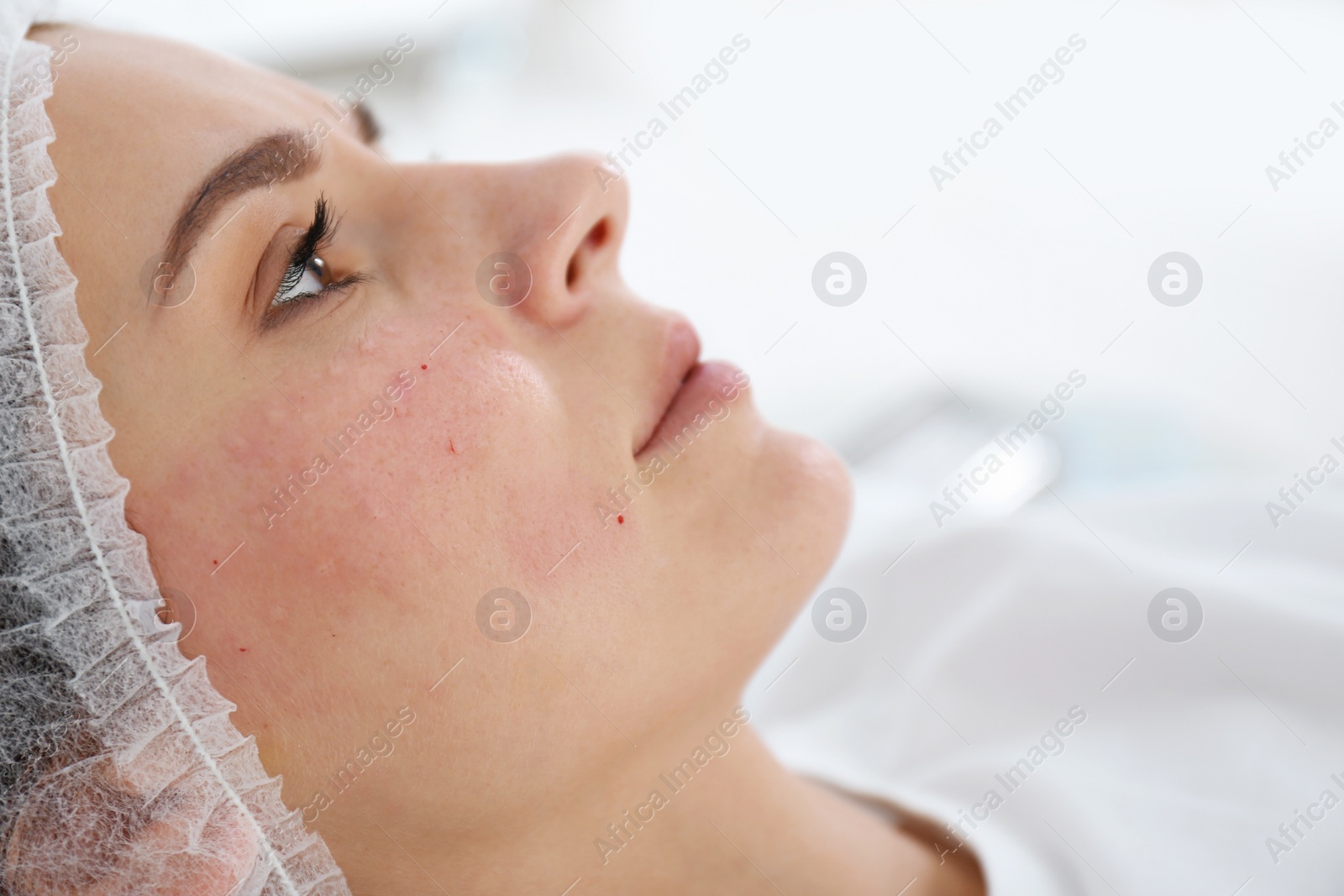 Photo of Woman after face biorevitalization procedure in salon, closeup. Cosmetic treatment