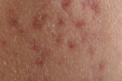 Photo of Texture of skin with acne problem as background, macro view