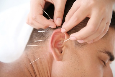 Young man undergoing acupuncture treatment in salon, closeup