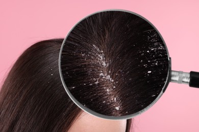 Woman suffering from dandruff on pink background, closeup. View through magnifying glass on hair with flakes