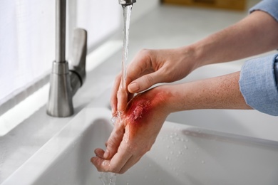 Photo of Woman holding hand with burn under flowing water indoors, closeup
