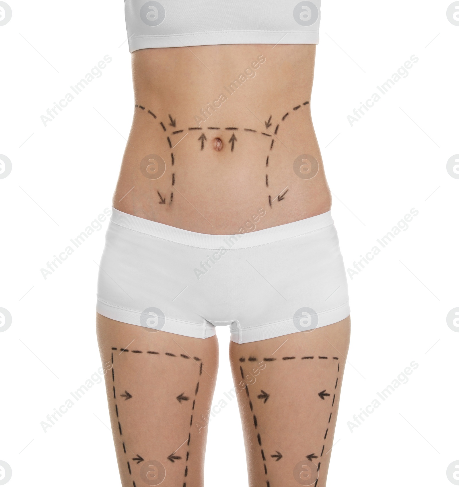 Photo of Young woman with marks on belly and legs for cosmetic surgery operation against white background