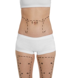 Photo of Young woman with marks on belly and legs for cosmetic surgery operation against white background