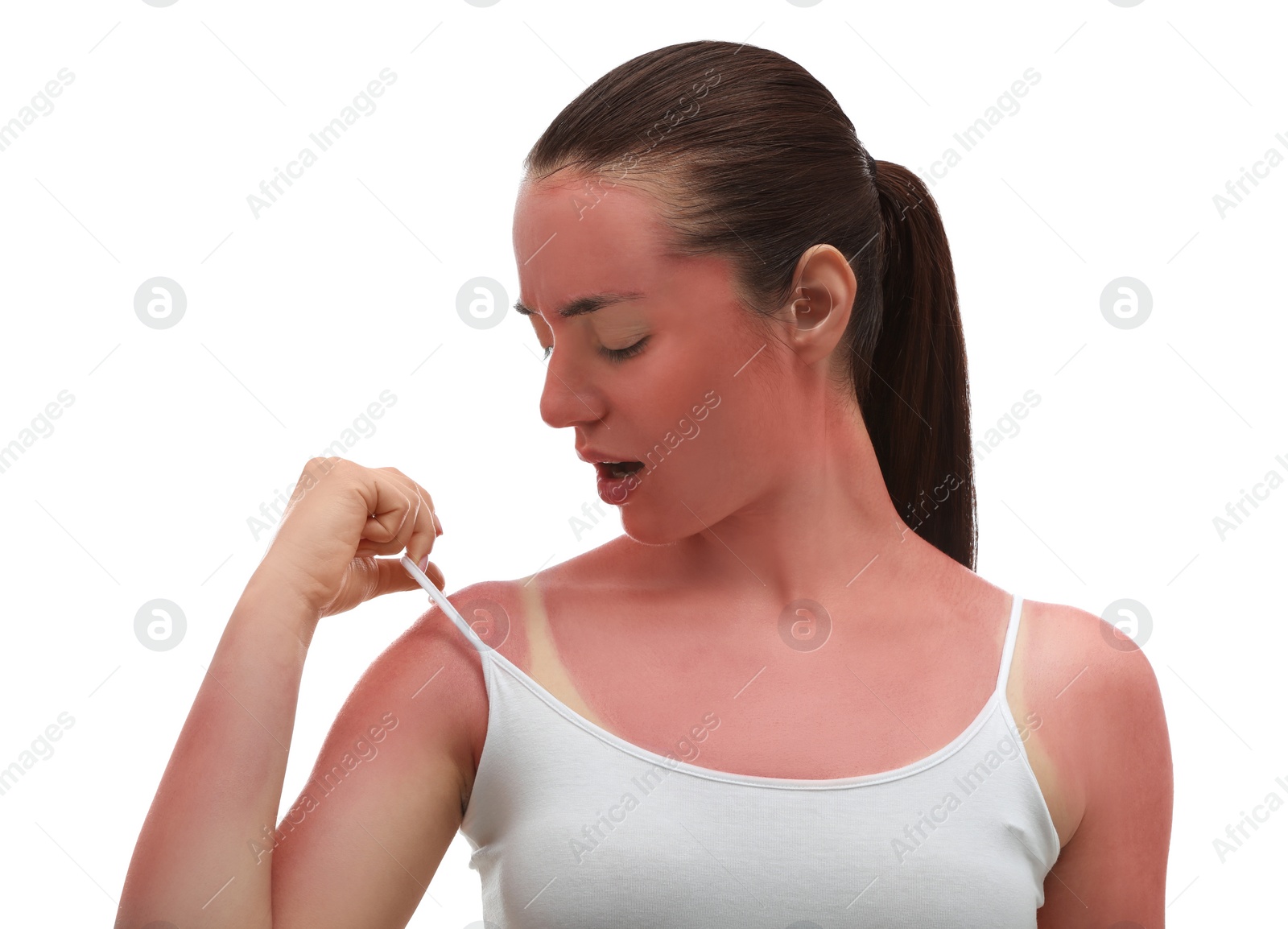 Photo of Woman with sunburned skin on white background