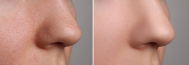 Image of Before and after acne treatment. Photos of woman on grey background, closeup. Collage showing affected and healthy skin