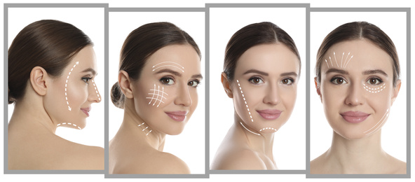 Image of Photos of young woman with lifting marks on face against white background, collage. Cosmetic surgery