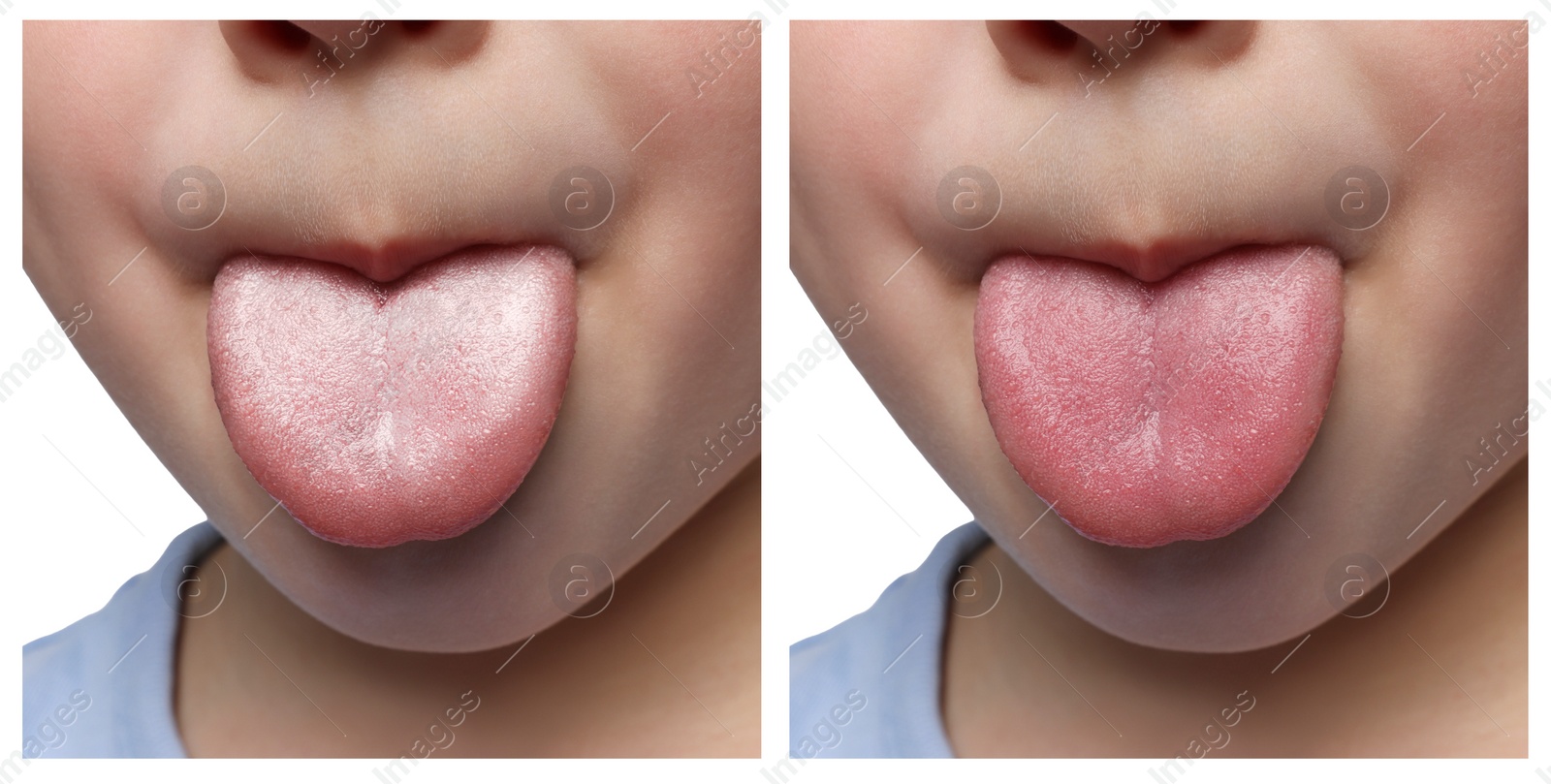 Image of Collage with photos of kid before and after tongue cleaning, closeup