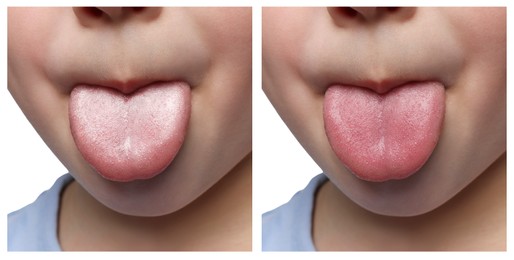 Image of Collage with photos of kid before and after tongue cleaning, closeup