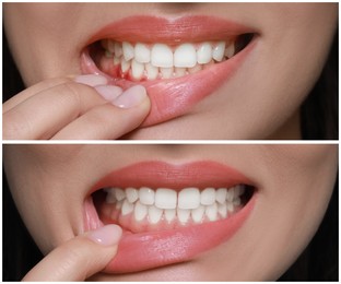 Woman showing gum before and after treatment, collage of photos