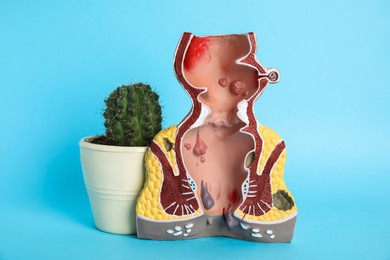 Photo of Model of unhealthy lower rectum with inflamed vascular structures and cactus on light blue background. Hemorrhoid problem