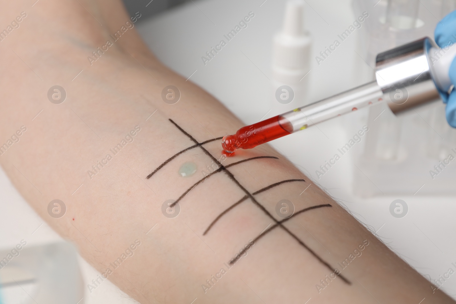 Photo of Patient undergoing skin allergy test at light table in clinic, closeup