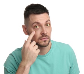 Photo of Man checking his health condition on white background. Yellow eyes as symptom of problems with liver