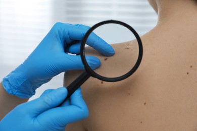 Photo of Dermatologist examining patient's birthmark with magnifying glass in clinic, closeup view
